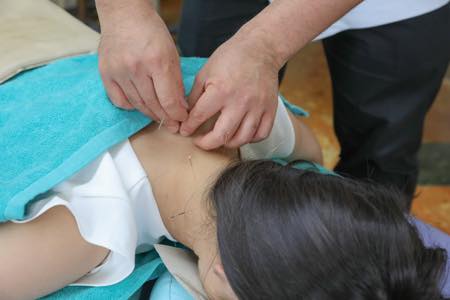西が丘整骨院　灸頭鍼の様子